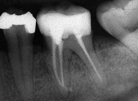 Endodontie Kompakt Röntgenbild